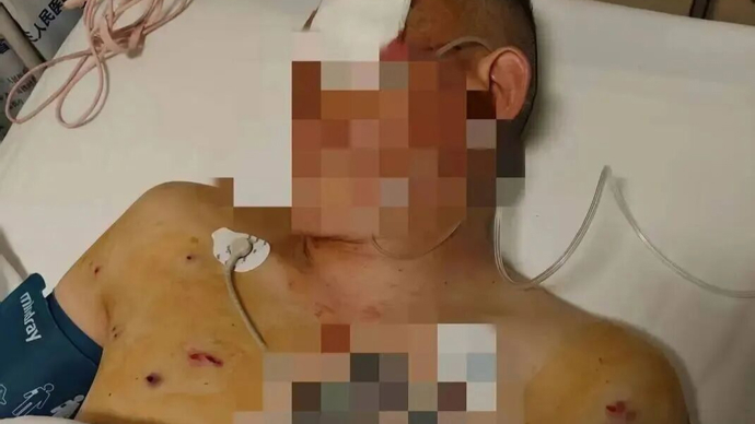 中国农业银行中牟县支行回应客户遭抢事件_男子取款170万银行门口遭抢致重伤 银行保安未帮忙应担责_取170万遭抢当事人：歹徒照头就一枪