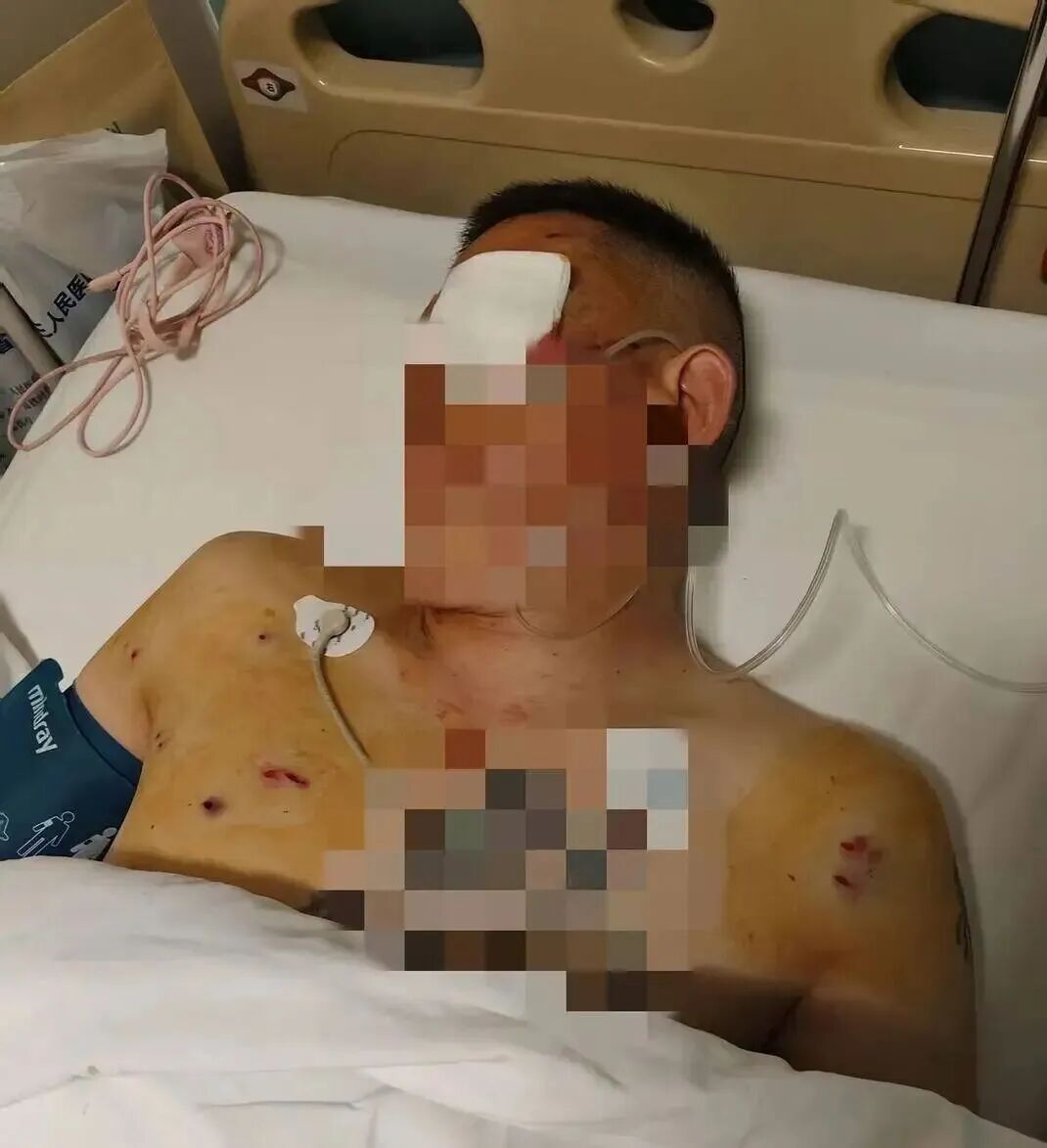 中国农业银行中牟县支行回应客户遭抢事件_取170万遭抢当事人：歹徒照头就一枪_男子取款170万银行门口遭抢致重伤 银行保安未帮忙应担责