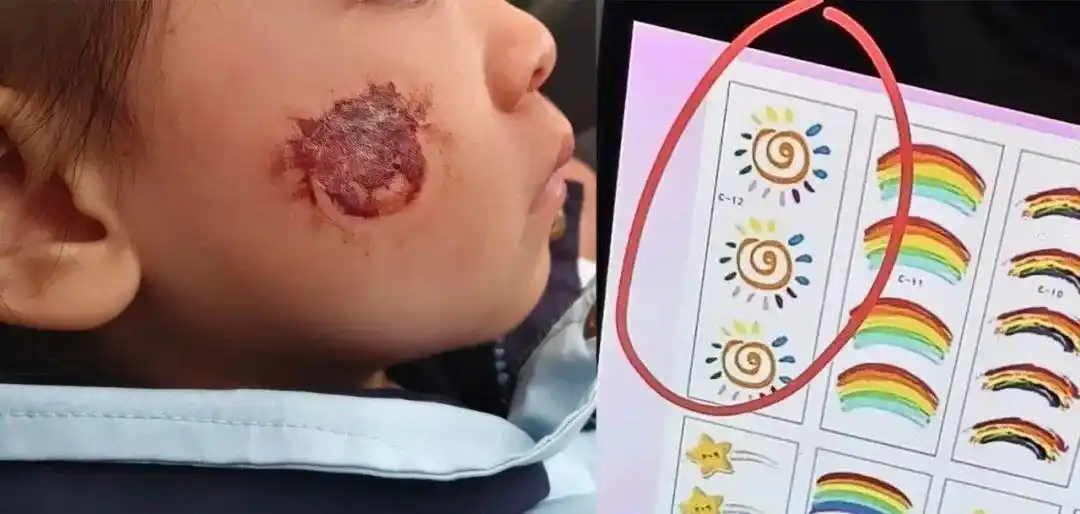 家长懊悔不已,网购贴纸竟致3岁女童脸部糜烂